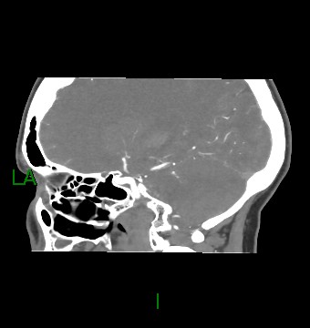 File:Aneurysmal subarachnoid hemorrhage with intra-axial extension (Radiopaedia 84371-99732 B 41).jpg