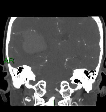 Aneurysmal subarachnoid hemorrhage with intra-axial extension (Radiopaedia 84371-99732 C 44).jpg