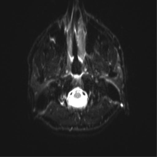 Angular epidermoid cyst (Radiopaedia 46908-51438 Axial DWI 39).png