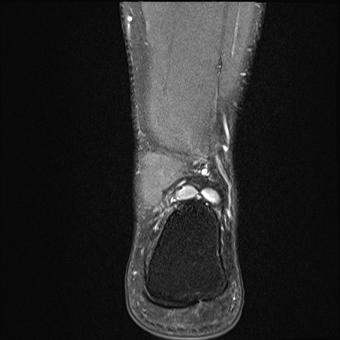 Ankle syndesmotic injury (Radiopaedia 69066-78837 Coronal PD fat sat 13).jpg