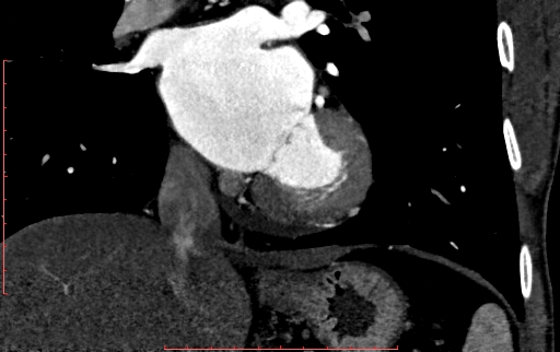 Anomalous left coronary artery from the pulmonary artery (ALCAPA) (Radiopaedia 70148-80181 B 196).jpg