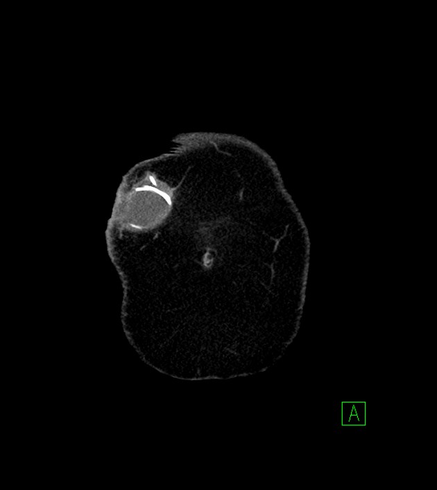 Anterior abdominal wall CSF pseudocyst (CSFoma) (Radiopaedia 79453-92571 B 5).jpg