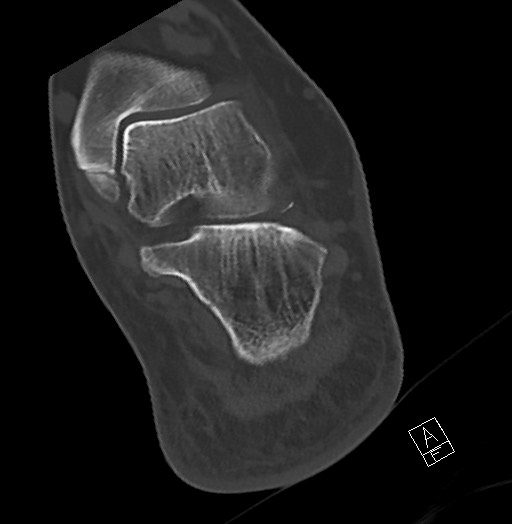 Anterior calcaneal process fracture (Radiopaedia 63353-71943 Axial bone window 102).jpg