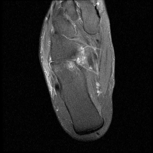 File:Anterior calcaneal process fracture (Radiopaedia 71377-81705 Axial PD fat sat 13).jpg