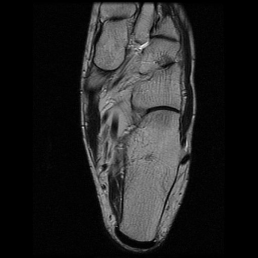 File:Anterior calcaneal process fracture (Radiopaedia 74654-85611 Axial T2 20).jpg