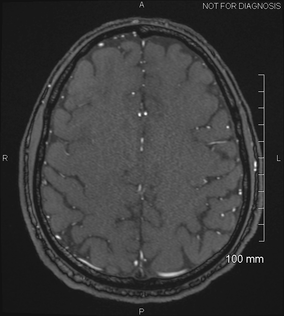 Anterior cerebral artery aneurysm (Radiopaedia 80683-94127 Axial MRA 187).jpg