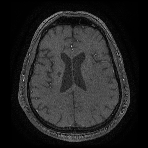 Anterior cerebral artery infarction (Radiopaedia 46794-51323 Axial MRA 143).jpg