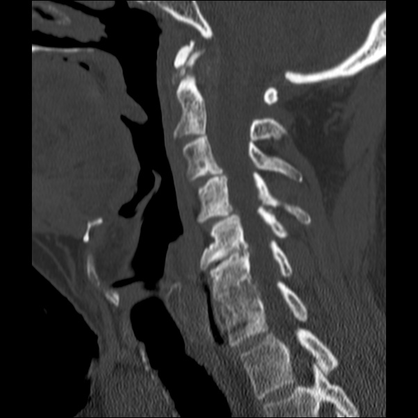 Anterior cervical postdiscectomy arthrodesis (Radiopaedia 32678-33646 Sagittal bone window 31).jpg