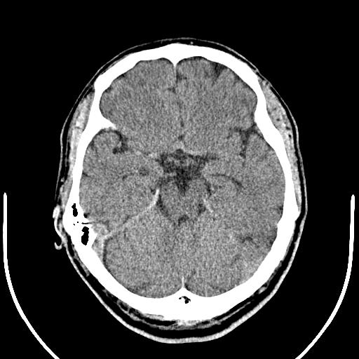 Anterior choroidal artery infarct (Radiopaedia 55106-61480 Axial non-contrast 19).jpg