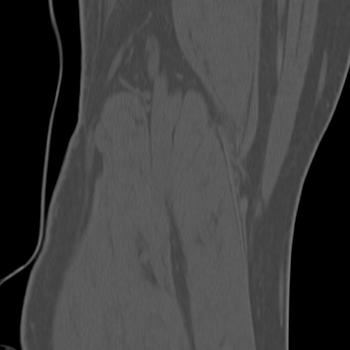 File:Anterior cruciate ligament avulsion fracture (Radiopaedia 58939-66194 Coronal bone window 34).jpg
