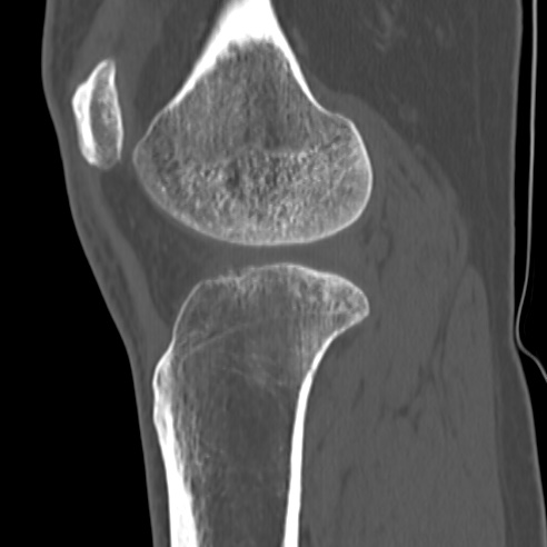 File:Anterior cruciate ligament avulsion fracture (Radiopaedia 58939-66194 Sagittal bone window 13).jpg