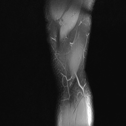 File:Anterior cruciate ligament full thickness tear (Radiopaedia 66268-75467 Sagittal PD fat sat 23).jpg