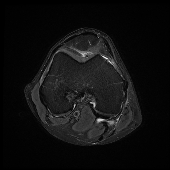 File:Anterior cruciate ligament graft tear and bucket-handle tear of medial meniscus (Radiopaedia 75867-87254 Axial PD fat sat 16).jpg