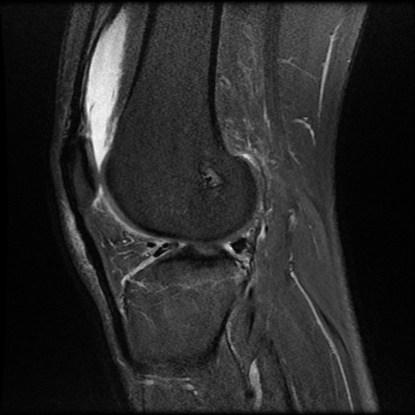 File:Anterior cruciate ligament graft tear and bucket-handle tear of medial meniscus (Radiopaedia 75867-87255 Sagittal PD fat sat 19).jpg