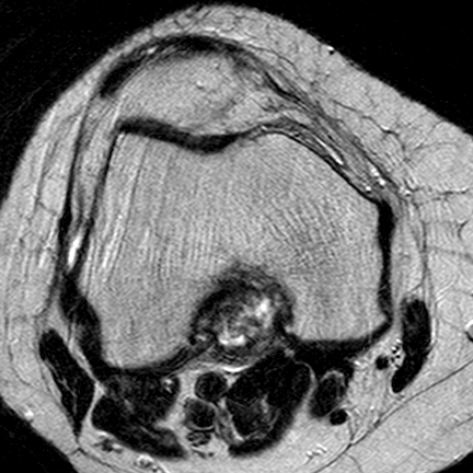 File:Anterior cruciate ligament mucoid degeneration (Radiopaedia 60853-68633 Axial T2 19).jpg