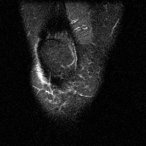 File:Anterior cruciate ligament mucoid degeneration (Radiopaedia 60853-68633 Coronal STIR 8).jpg