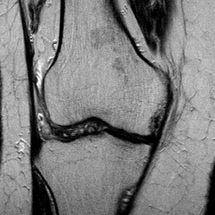 File:Anterior cruciate ligament mucoid degeneration (Radiopaedia 60853-68633 Coronal T2 14).jpg