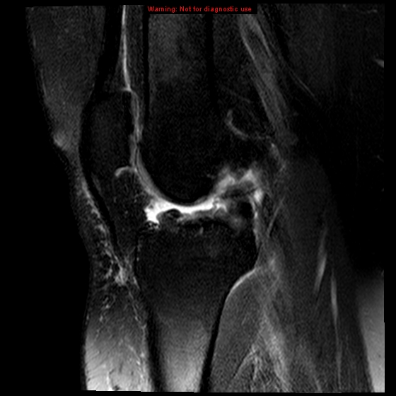 File:Anterior cruciate ligament tear (Radiopaedia 12329-12612 E 11).jpg