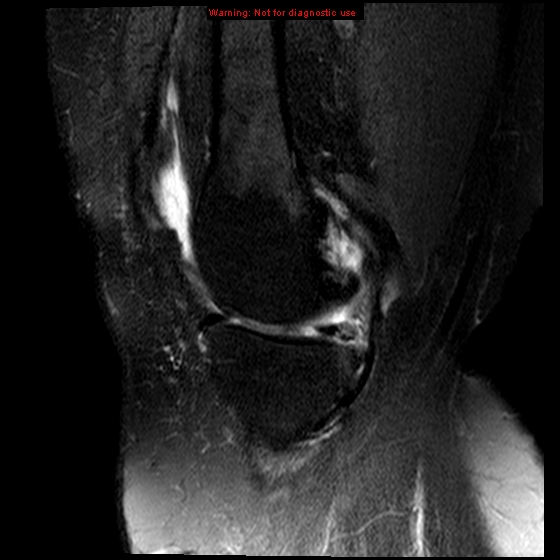 File:Anterior cruciate ligament tear (Radiopaedia 12329-12612 E 15).jpg