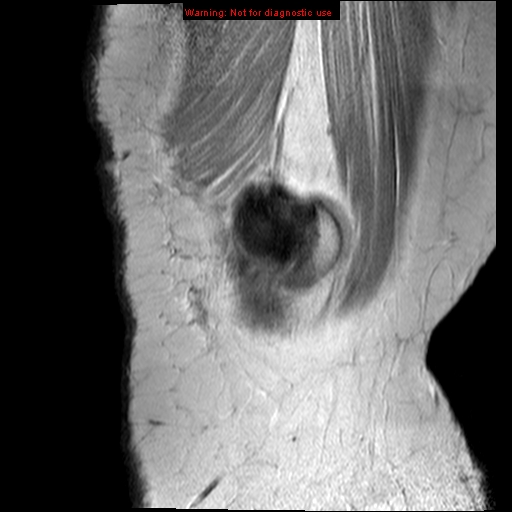 File:Anterior cruciate ligament tear (Radiopaedia 12329-12612 Sagittal T2 fat sat 20).jpg