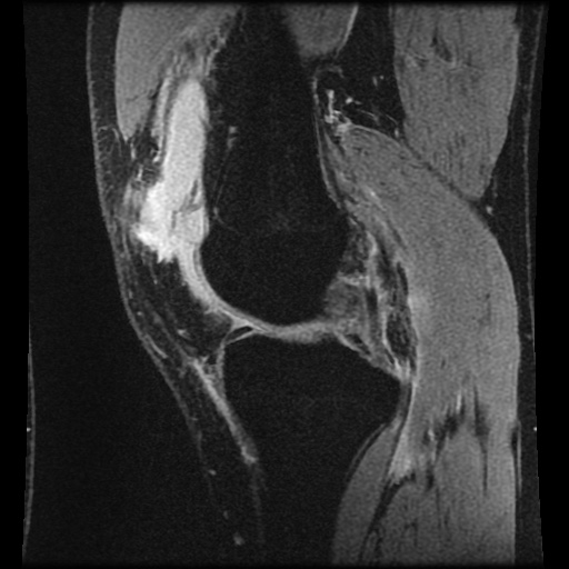 Anterior cruciate ligament tear (Radiopaedia 61500-69462 F 30).jpg