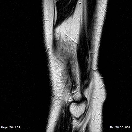 File:Anterior cruciate ligament tear (Radiopaedia 70783-80964 Sagittal T2 30).jpg