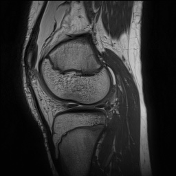 Anterior cruciate ligament tear - pediatric (Radiopaedia 62152-70260 Sagittal PD 122).jpg