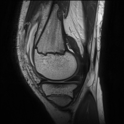 Anterior cruciate ligament tear - pediatric (Radiopaedia 62152-70260 Sagittal PD 54).jpg