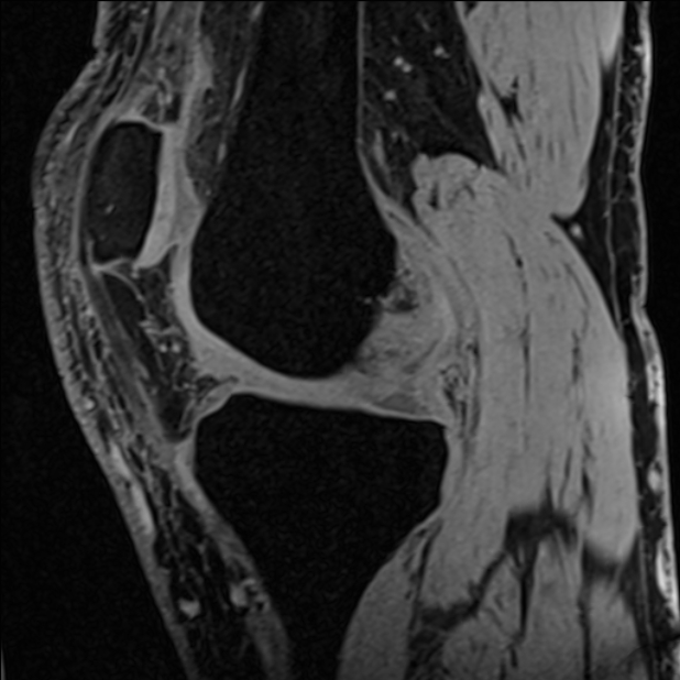 Anterior cruciate ligament tear - ramp lesion (Radiopaedia 71883-82322 Sagittal T1 vibe 87).jpg