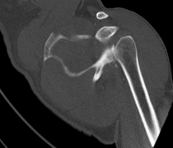 Anterior shoulder dislocation with Hill-Sachs and bony Bankart lesions (Radiopaedia 40424-42974 Coronal bone window 28).png