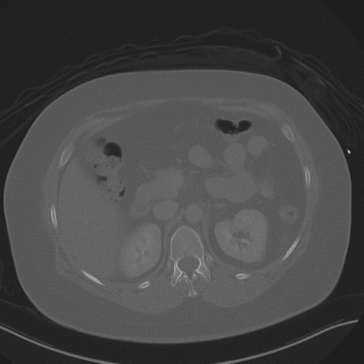File:Anterior superior iliac spine avulsion fracture (Radiopaedia 44541-48244 Axial bone window 33).png