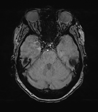 Anterior temporal pole cysts (Radiopaedia 46629-51102 Axial SWI 29).png