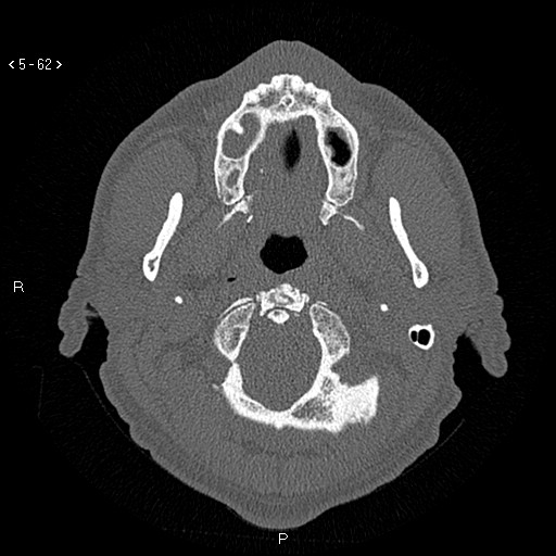 Antrochoanal Polyp (Radiopaedia 70510-80631 Axial bone window 10).jpg