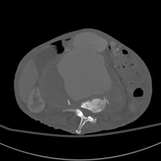 Aortic aneurysm with spinal destruction (Radiopaedia 42301-45410 Axial bone window 46).jpg