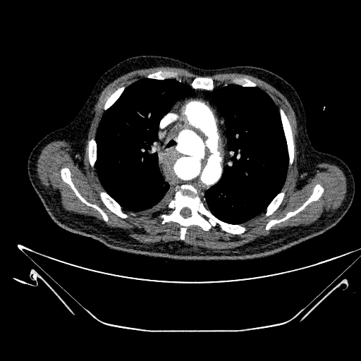 Aortic arch aneurysm (Radiopaedia 84109-99365 B 230).jpg