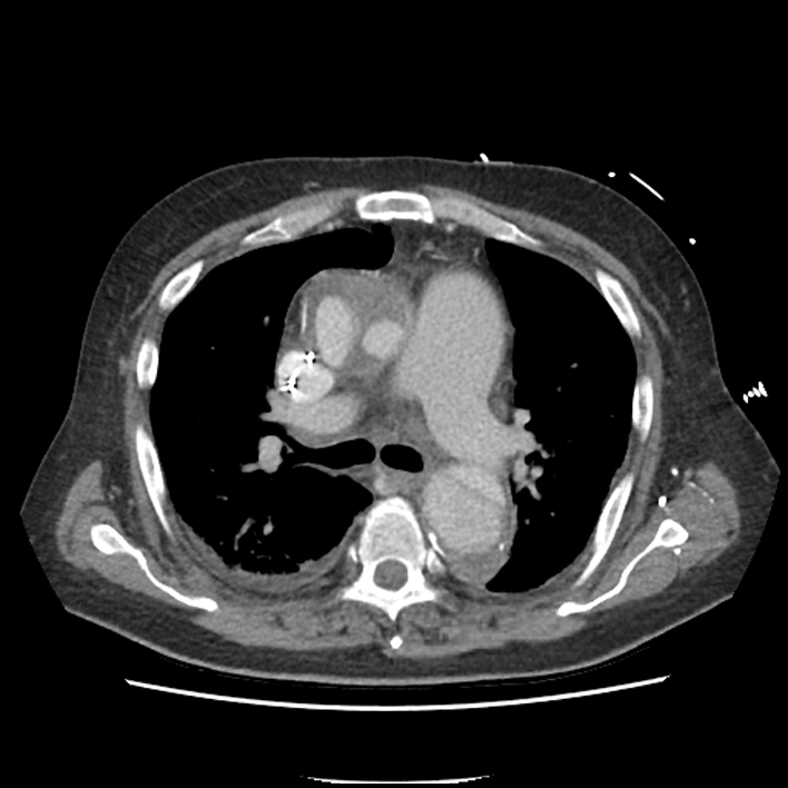 Aortic arch graft infection (FDG PET-CT) (Radiopaedia 71975-82437 A 22).jpg