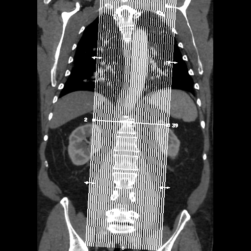 File:Aortic dissection- Stanford A (Radiopaedia 37759-39664 Sagittal C+ delayed 1).png