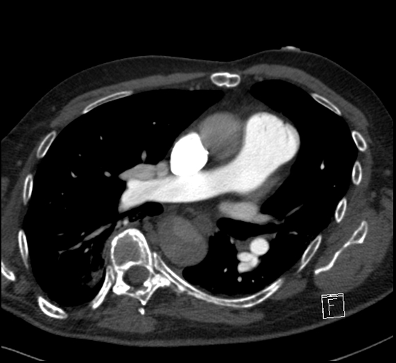 File:Aortic dissection (CTPA) (Radiopaedia 75506-86751 Axial C+ CTPA 70).jpg