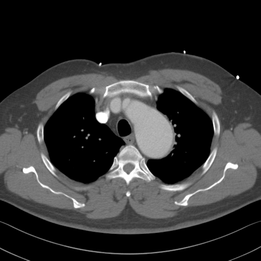 File:Aortic dissection (Radiopaedia 50763-56234 A 10).png