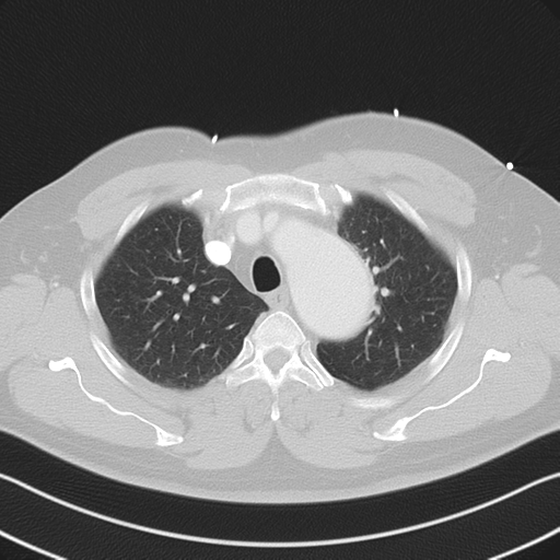 File:Aortic dissection (Radiopaedia 50763-56234 Axial lung window 21).png