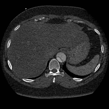 File:Aortic dissection (Radiopaedia 57969-64959 A 273).jpg