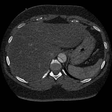File:Aortic dissection (Radiopaedia 57969-64959 A 286).jpg