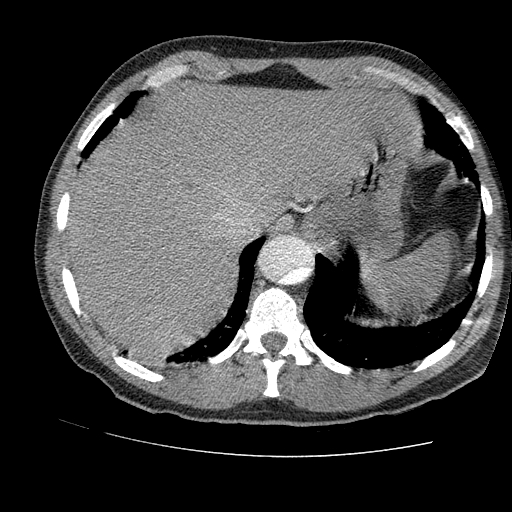 File:Aortic dissection - Stanford A -DeBakey I (Radiopaedia 28339-28587 B 89).jpg