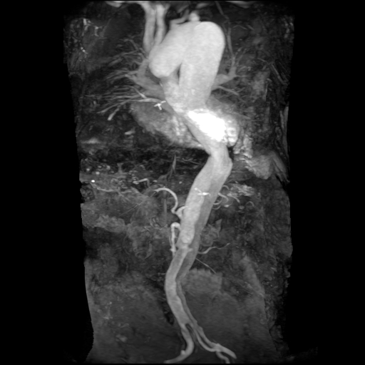 File:Aortic dissection - Stanford A - DeBakey I (Radiopaedia 23469-23551 MRA 24).jpg