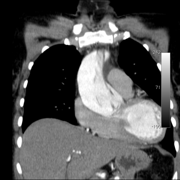 Aortic dissection - Stanford type A (Radiopaedia 29247-29659 B 21).jpg