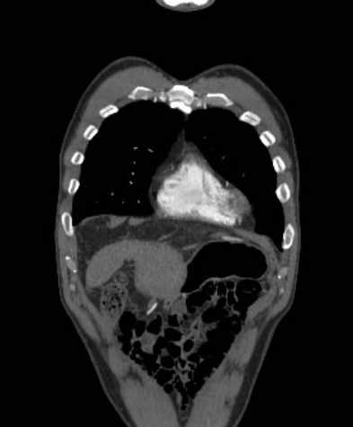 Aortic dissection - Stanford type B (Radiopaedia 73648-84437 B 22).jpg