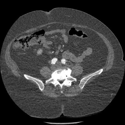 Aortic dissection - Stanford type B (Radiopaedia 88281-104910 A 133).jpg