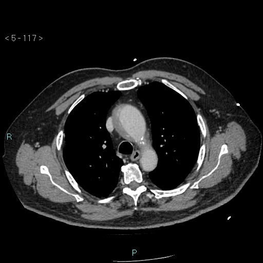 Aortic intramural hematoma (Radiopaedia 48463-53380 C 53).jpg