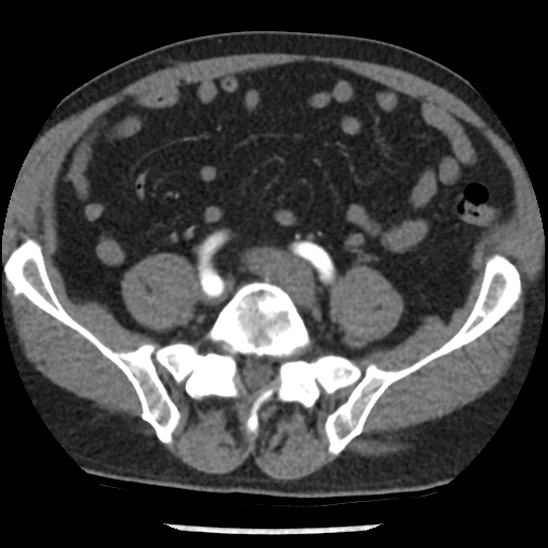 Aortic intramural hematoma (type B) (Radiopaedia 79323-92387 B 89).jpg