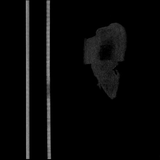 File:Aortic intramural hematoma from penetrating atherosclerotic ulcer (Radiopaedia 31137-31836 C 73).jpg